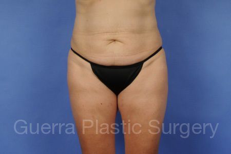 Case #11547 Before