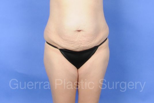 Case #01229 Before