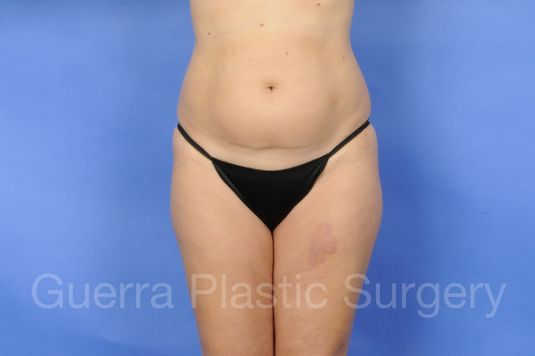 Case #01230 Before
