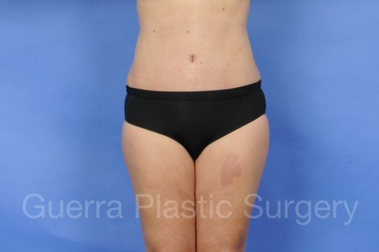 Case #01230 After