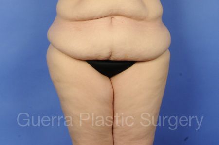 Case #01236 Before