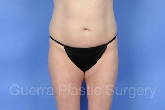Case #01237 Before