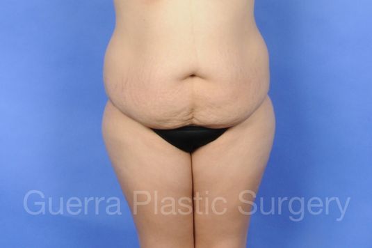 Case #01238 Before