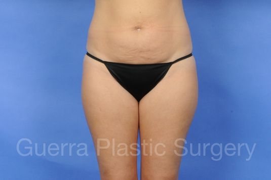 Case #01241 Before