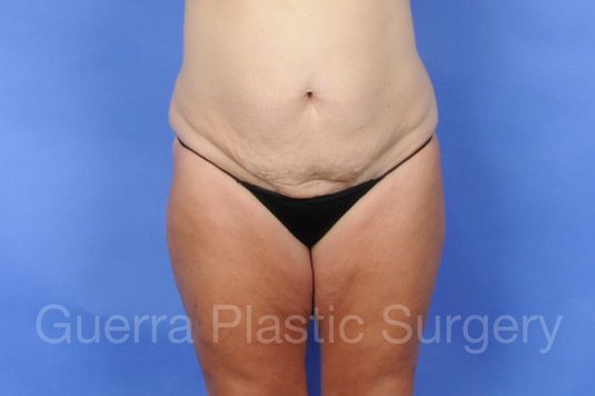 Case #01242 Before