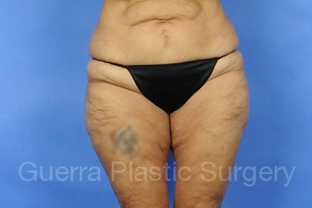 Case #01245 Before