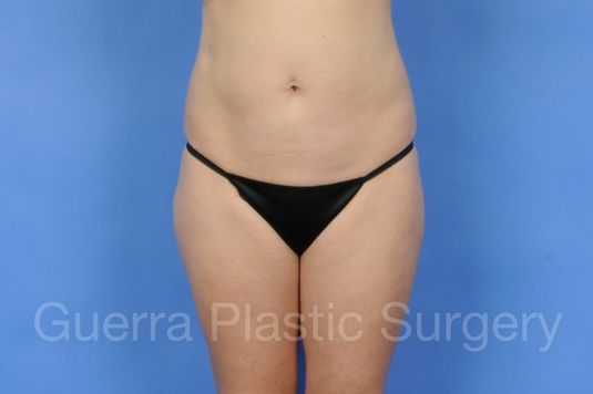 Case #01246 Before