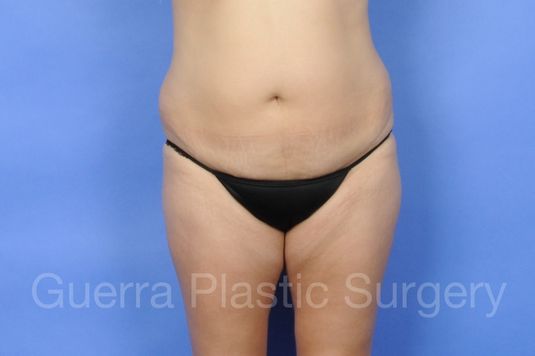 Case #01249 Before