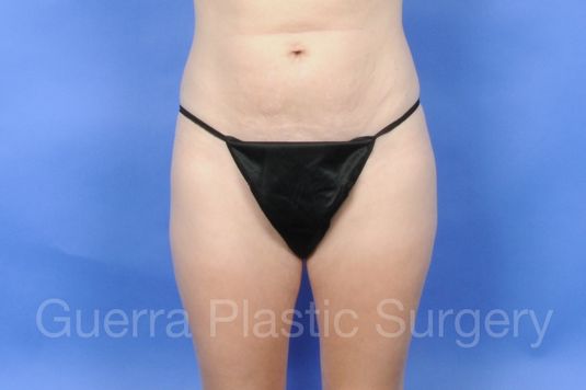 Case #01252 Before