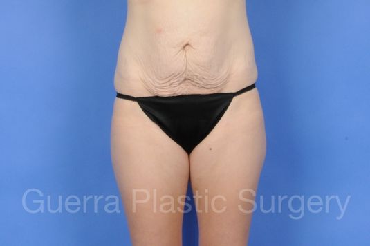 Case #01257 Before