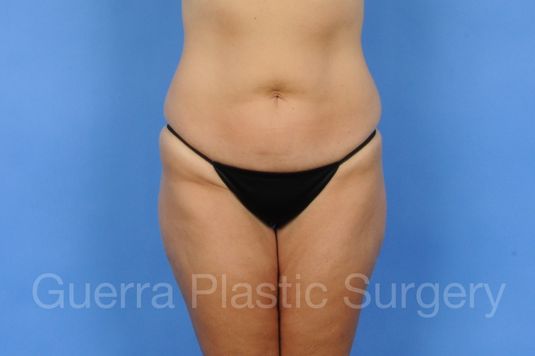 Case #01258 Before