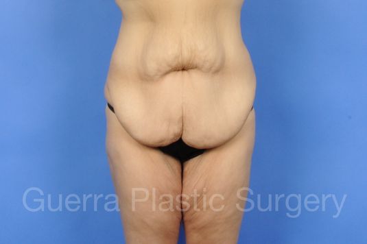 Case #01260 Before
