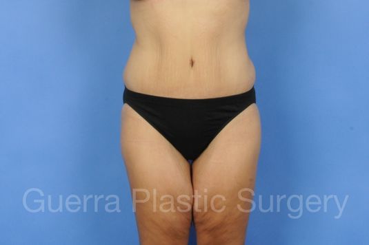 Case #01260 After