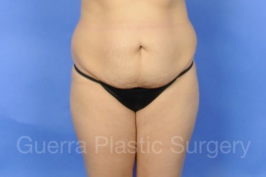 Case #01264 Before