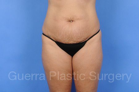 Case #01265 Before