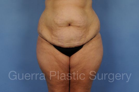 Case #01269 Before