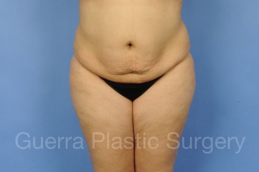 Case #01271 Before