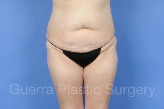 Case #01272 Before