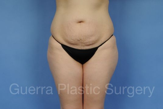 Case #19126 Before