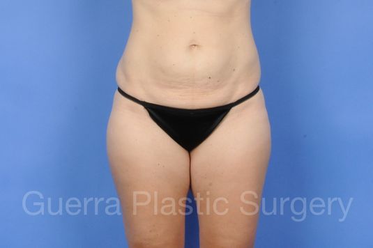 Case #01275 Before