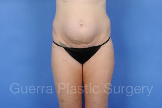 Case #01276 Before