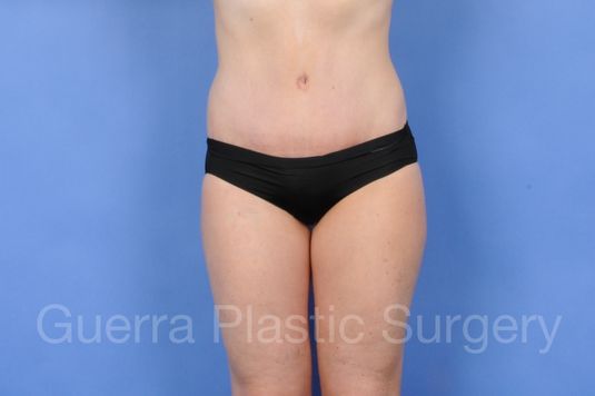 Case #01276 After