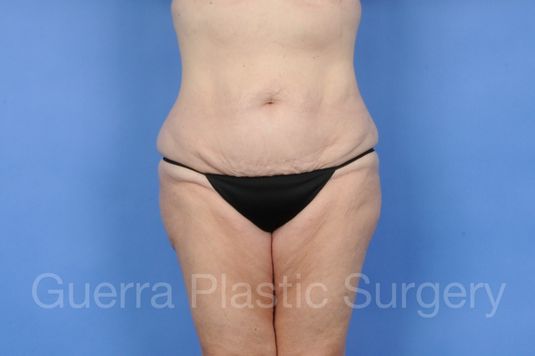 Case #01277 Before