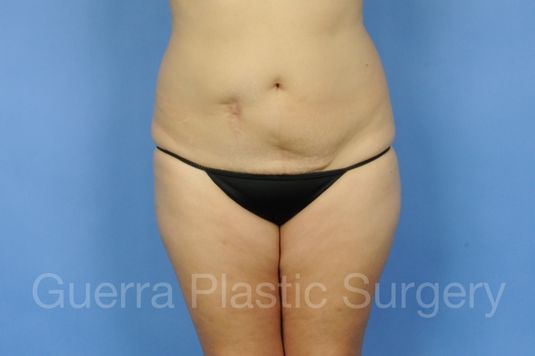 Case #01279 Before