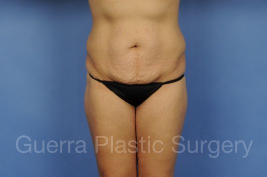 Case #01280 Before