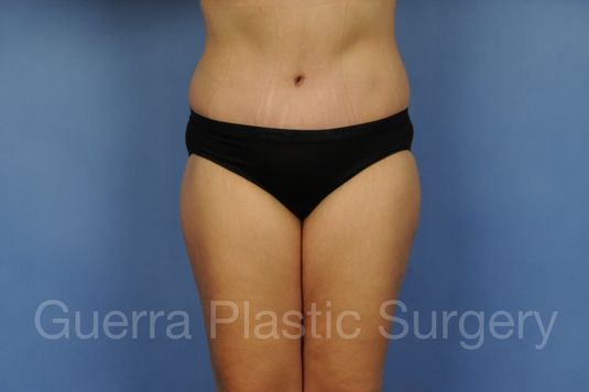 Case #01280 After