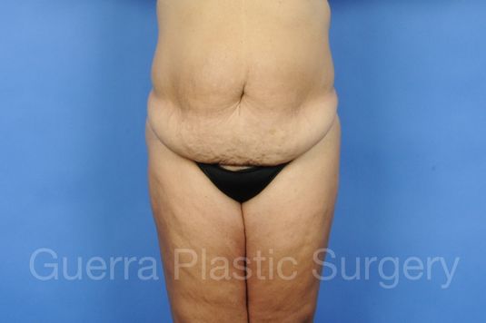 prev Case #13293 Before