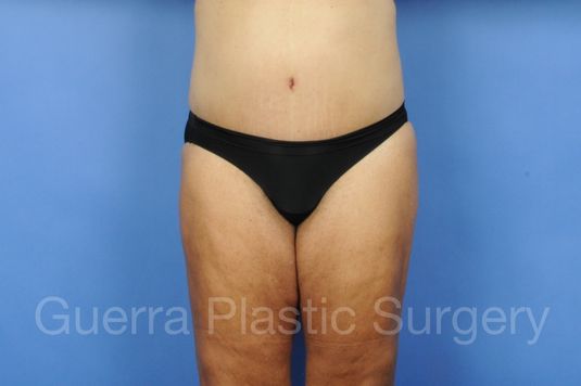 prev Case #13293 After