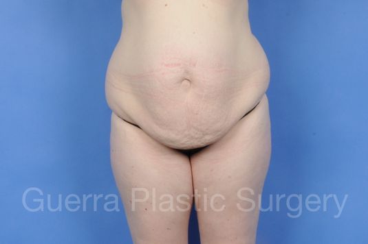 next Case #01285 Before