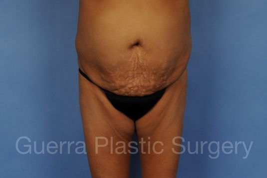 Case #01287 Before