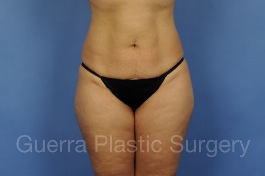 prev Case #3013 Before