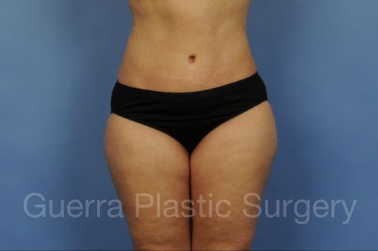 prev Case #3013 After