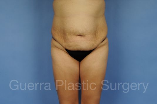 Case #01290 Before