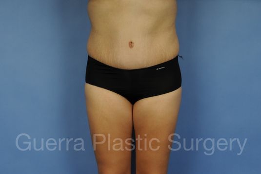 Case #01290 After