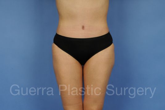 After Photo Tummy Tuck