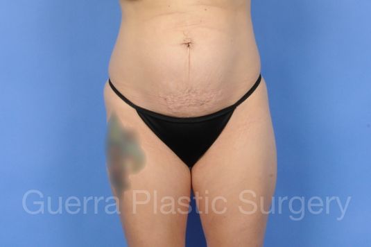 Case #01293 Before
