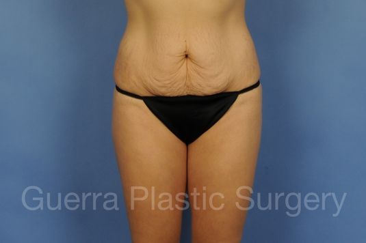 Case #01295 Before