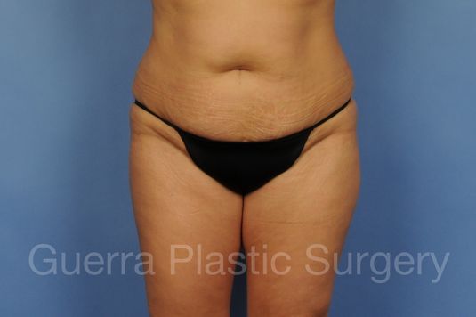 Case #01296 Before