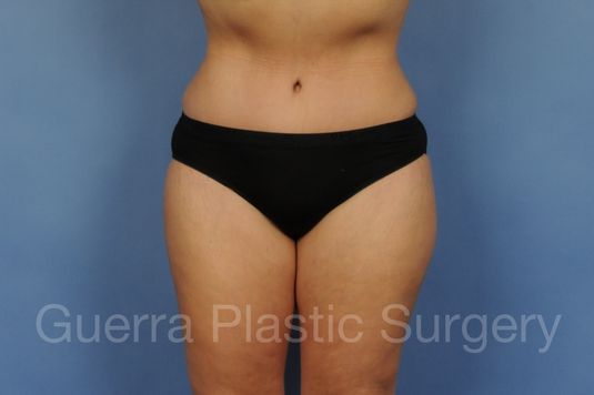 Case #01296 After