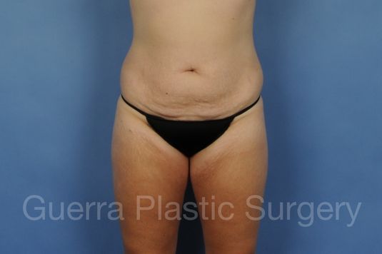 Case #01297 Before