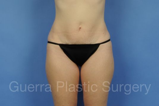 Case #18742 Before