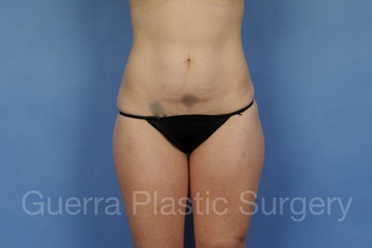 Case #01299 Before
