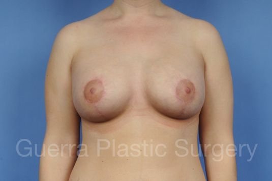 Case #1103017 After