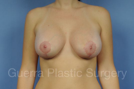 Case #1103018 After