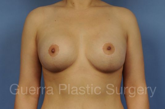 prev Case #1106007 After