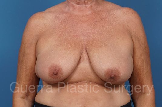 Case #35767 Before